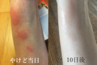 やけどの跡がキレイに